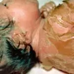 кожа при ихтиозе арлекина у младенца